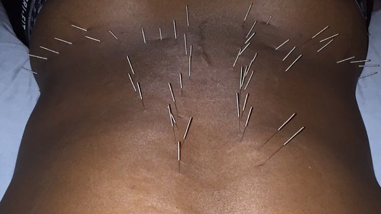 Acupuncture with a kick: Charged needles said to pump up results